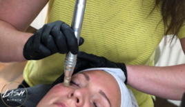 Microneedling Almere